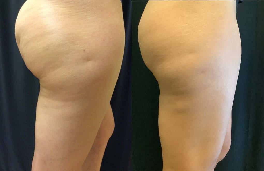 Cellulite Reduction Tampa FL